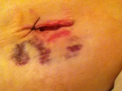 Incision two where the PD cath use to be. 