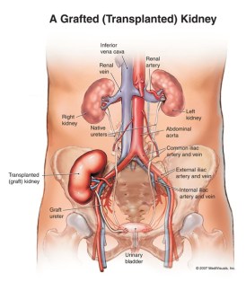 kidney-transplantation